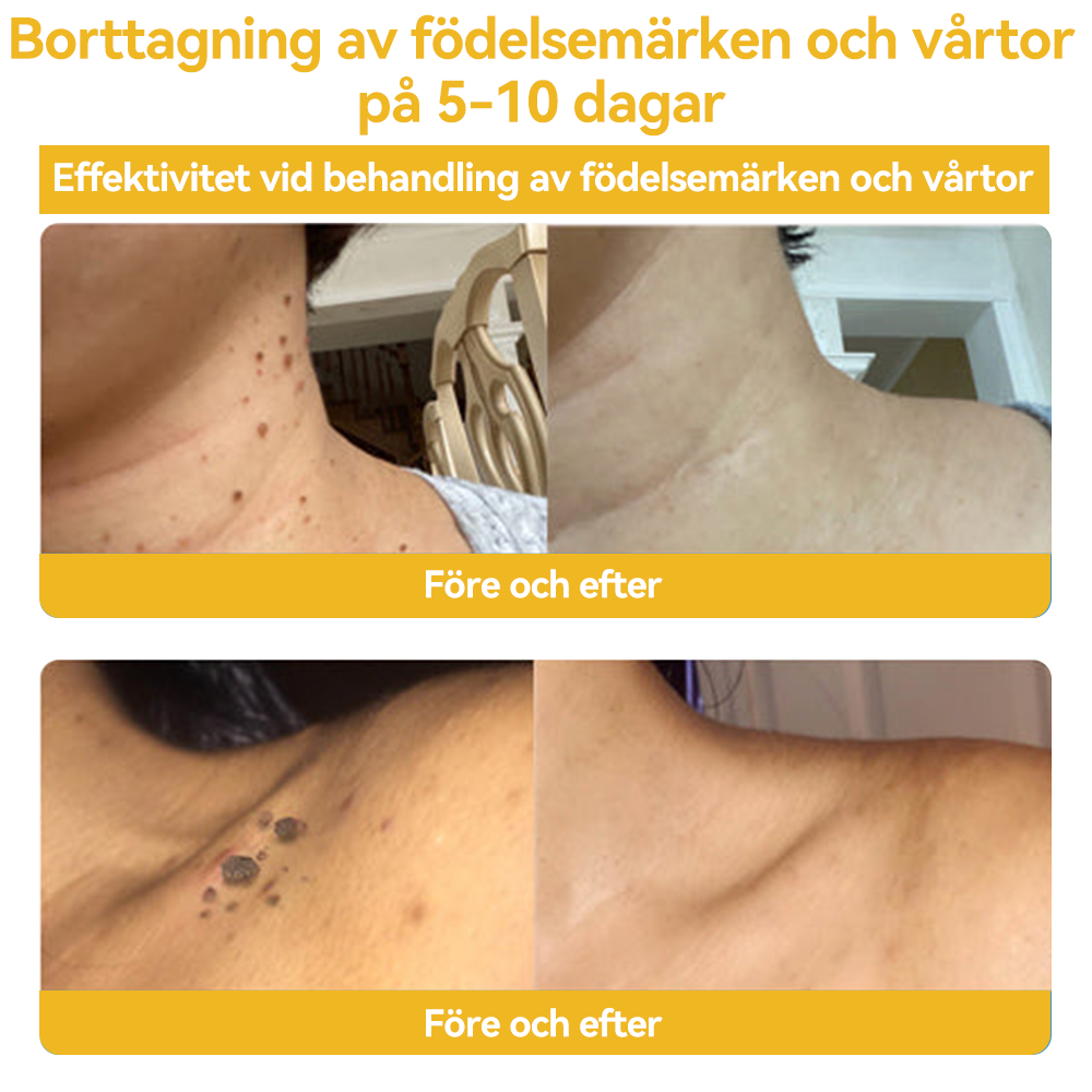 🔥Bara 4 lådor kvar! Vi erbjuder dig ytterligare 50% rabatt! Dermatologiskt testad, 4-6 flaskor räcker för att helt reparera din hud utan återfall. Missa inte och vänta ytterligare ett år 💥