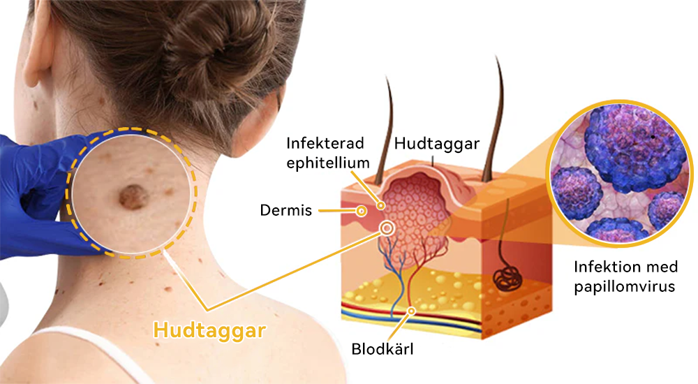 🔥Bara 4 lådor kvar! Vi erbjuder dig ytterligare 50% rabatt! Dermatologiskt testad, 4-6 flaskor räcker för att helt reparera din hud utan återfall. Missa inte och vänta ytterligare ett år 💥